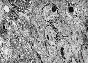 F,66y. | myositis F,66y. | myositis